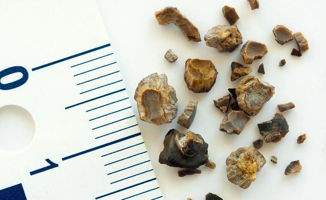 肾结石吃酸的什么原理_肾结石吃什么药