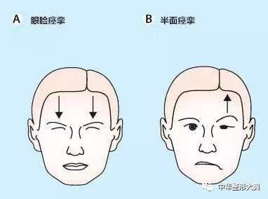 瞼 痙攣 下