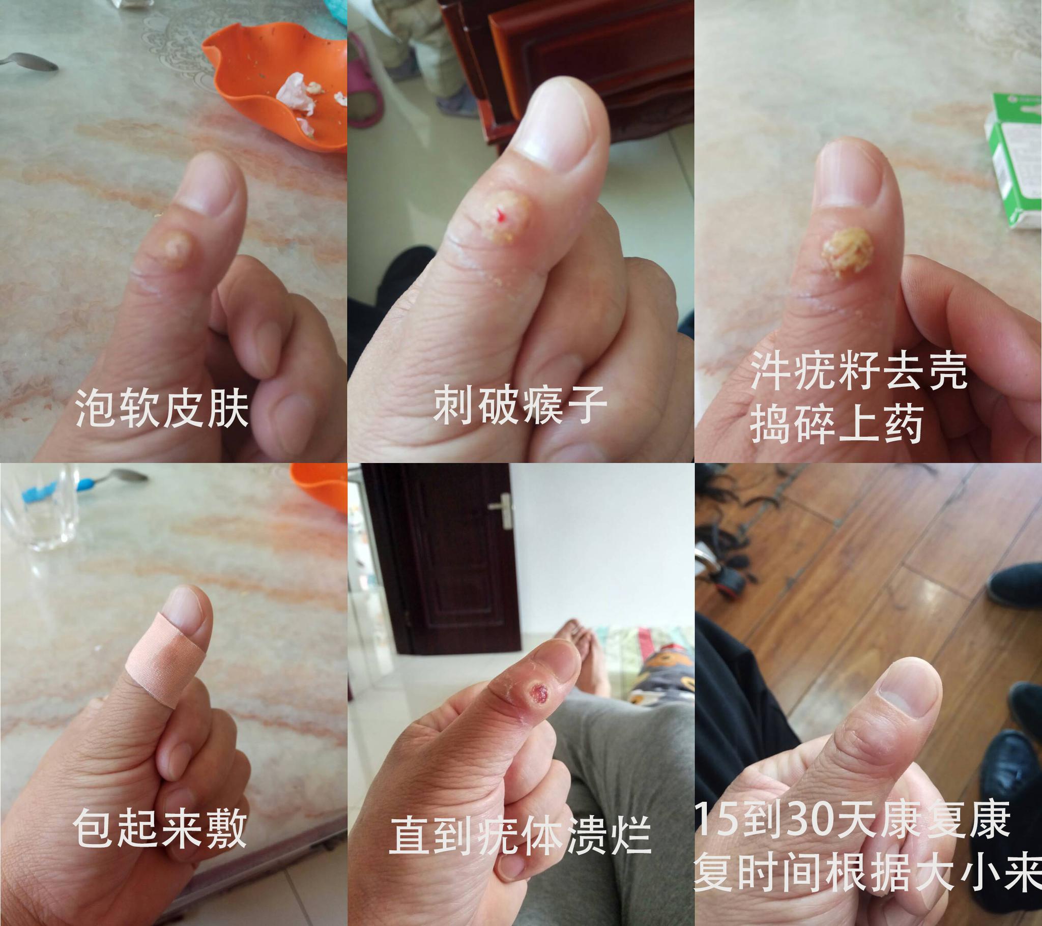 疣体治疗方法 冷冻疗法, 激光治疗,涂抹化学药物和中医治疗 如果寻常