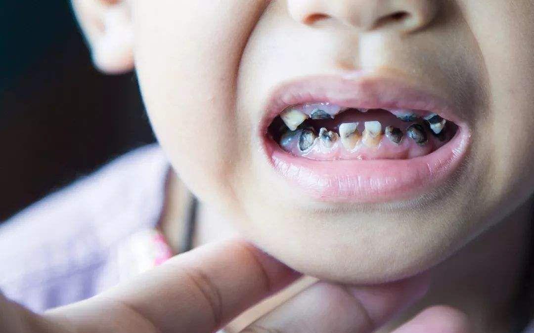 看起来就是很多人小时候长过的虫牙,于是她赶紧带着孩子去牙科检查