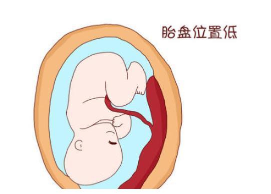 胎盘前置很常见，关键是怎么预防！