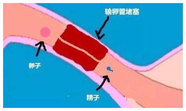 生过宝宝也会输卵管堵塞吗?