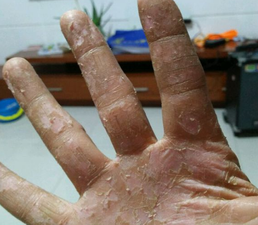 手部瘙痒如何判断是湿疹还是手癣