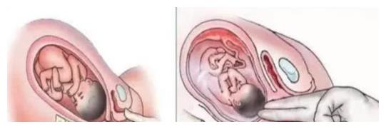 孕期被认最最最尴尬的检查:内检,孕妈你了解吗?