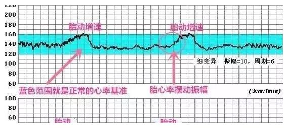 2,宫缩曲线