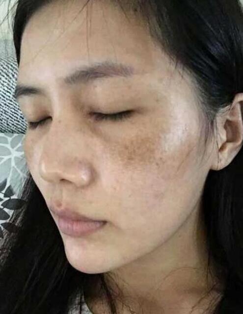 脸上有斑的人,睡前补充3种维生素,排出黑色素,黄褐斑都逃走了