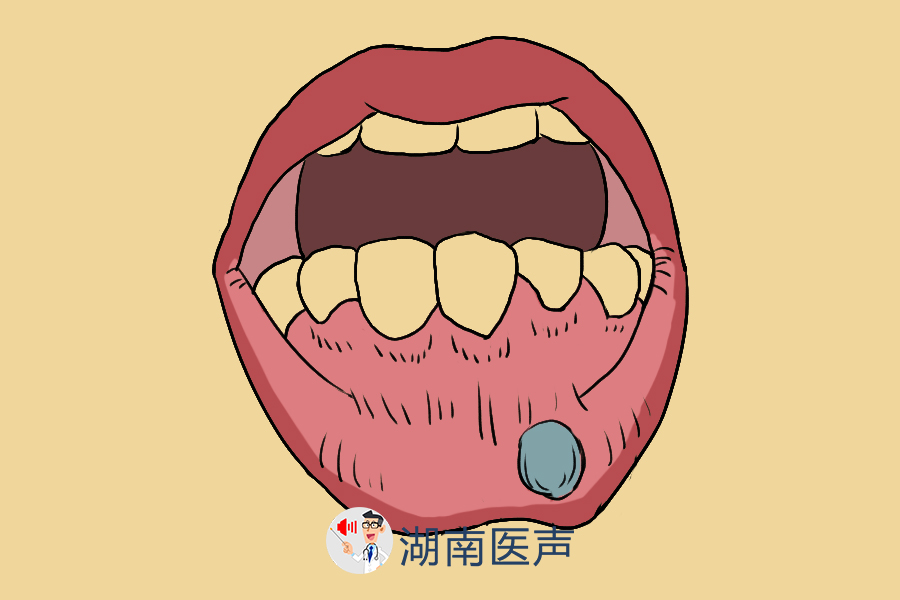 囊肿|粘液性|粘液腺_新浪新闻
