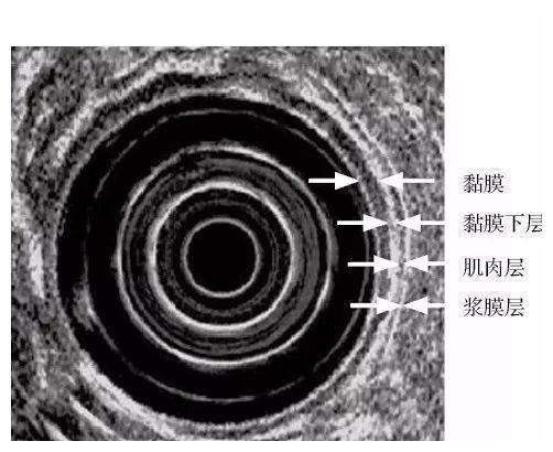 什么是超声内镜？哪些疾病需要做超声内镜？
