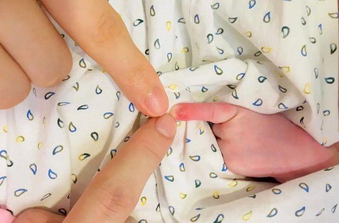5个月婴儿紧握拳头,奶奶发现不正常,去医院检查后全家