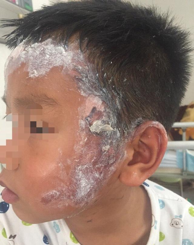 宝宝在丹阳一幼儿园被老师烫伤面部十级伤残,学校居然