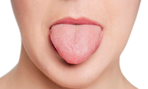初期 舌 癌