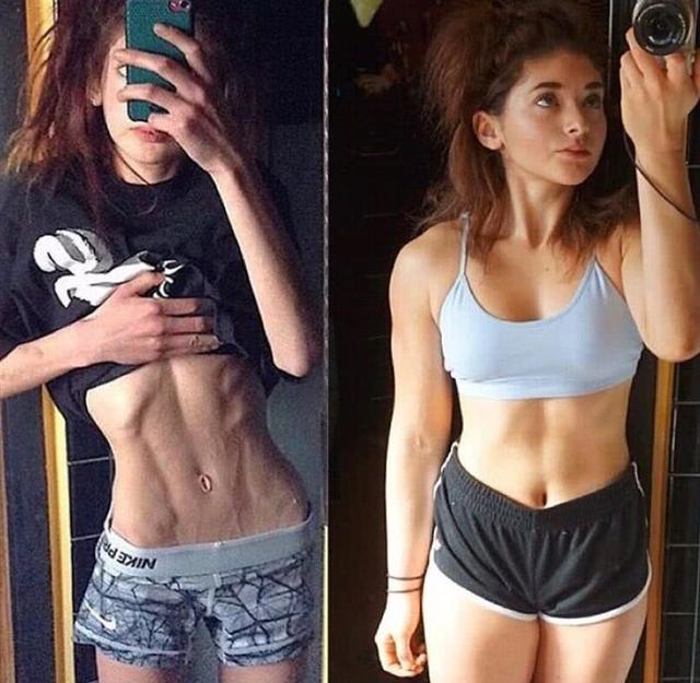 厌食症暴瘦女孩图片