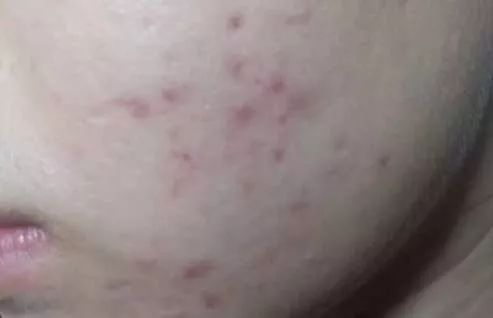 心好累!痘痘好了,又来了痘印!