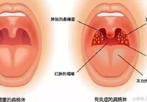 扁桃体切除能报销学生险吗 学平险可以报销孩子扁桃体