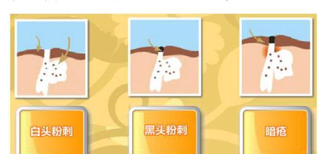 皮肤暗疮的形成和种类,深入了解痘痘,防止痘痘