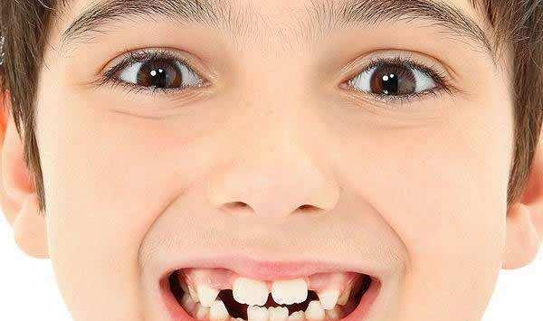 孩子换牙 牙齿长得很丑,不整齐怎么办 其实不用太担心!