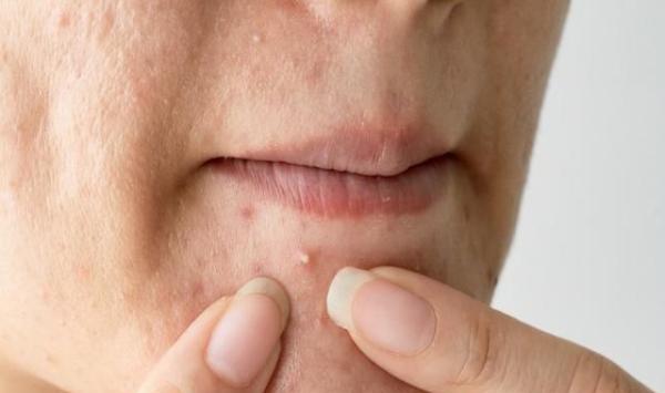 鼻子上挤出来的小米粒原来是螨虫的分泌物,教