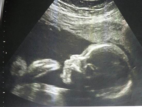 问下早期肝硬化怎么查出来？