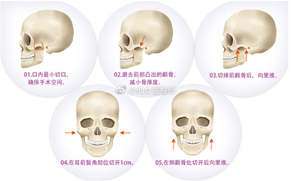 颧骨内推术图解,你的嫩牛五方脸有救了!