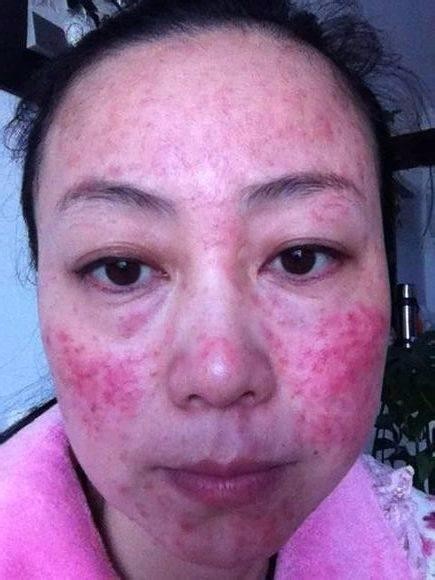 激素脸红肿一直不退要怎么消除 什么方法可以