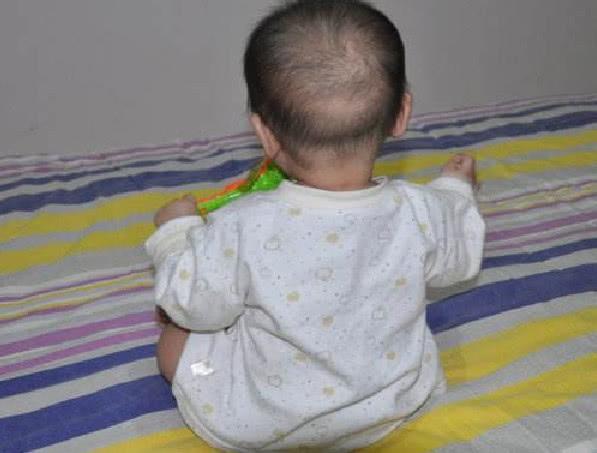 8个月宝宝摔下床后头上肿了大包,家长都没在意