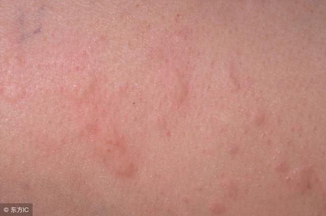 寒冷性荨麻疹的治疗方法是什么?别当成普通过