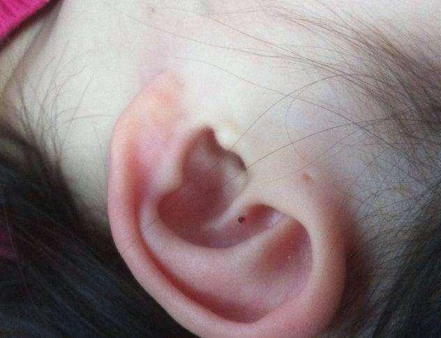 某地一个6岁的宝宝耳朵聋了,那么发生了什么呢?