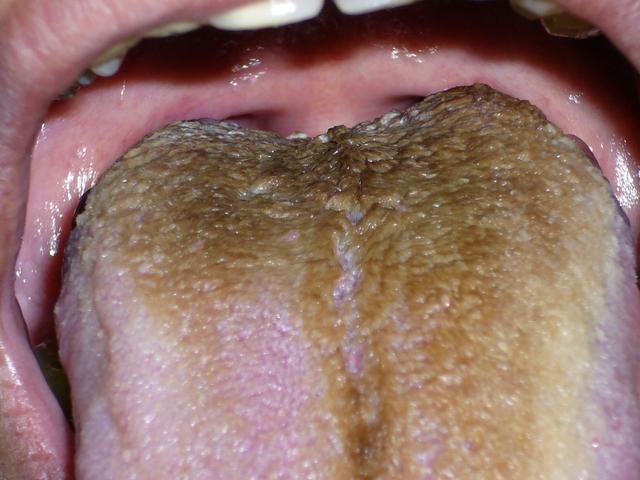 这4种舌苔都不正常