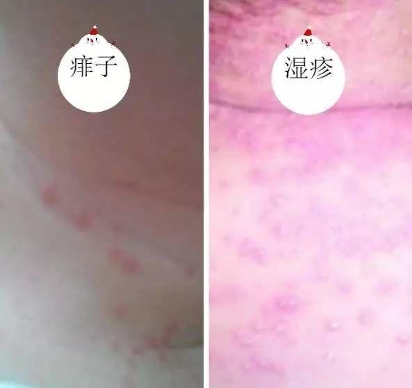 湿疹和热痱子的区别图片