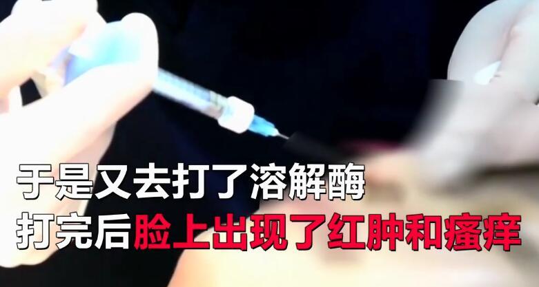 女子注射玻尿酸 脸肿像气球:爱美是一种什么体