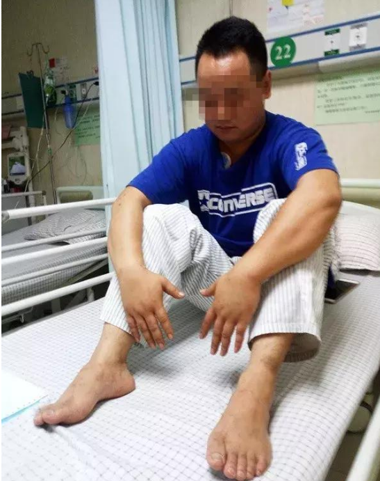 男子遭蚂蚁咬伤导致过敏性休克,什么蚂蚁这么