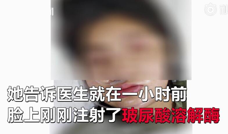 女子注射玻尿酸 脸肿像气球:爱美是一种什么体