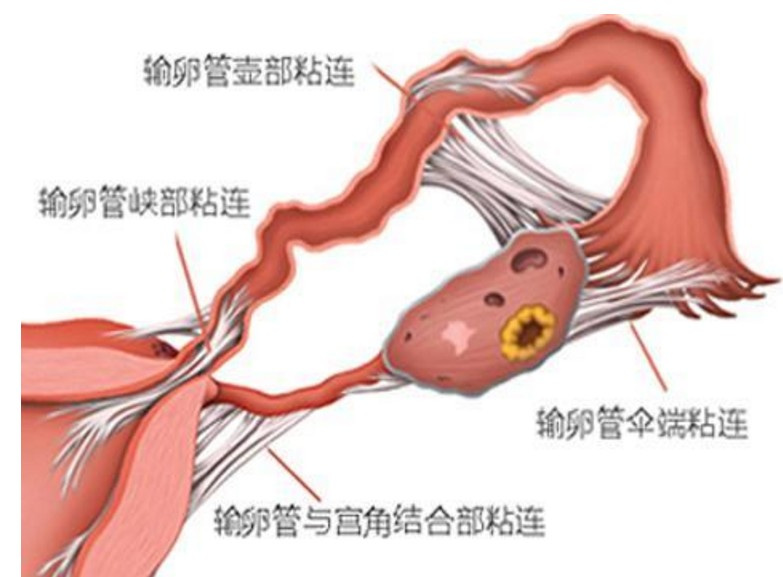 多处粘连坚持艾灸仍然可以怀孕生子(07)