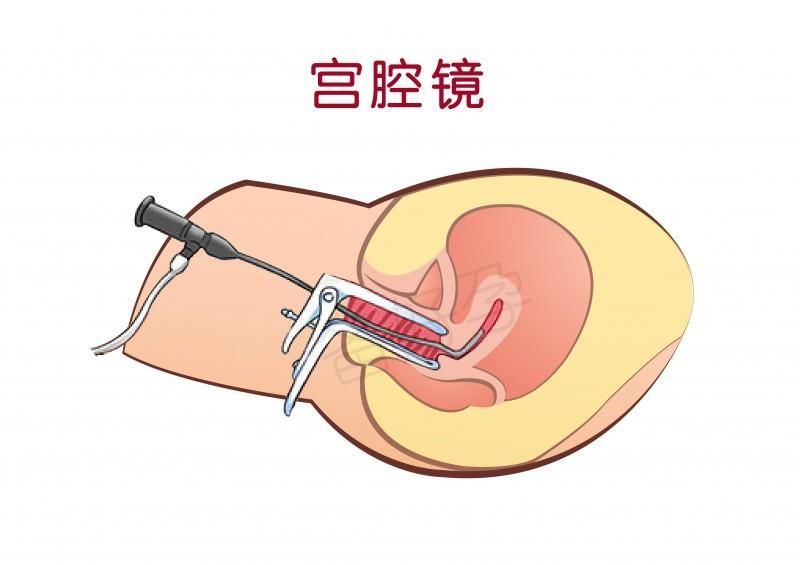 做宫腔镜伤害子宫更不好怀孕,是真的吗?!