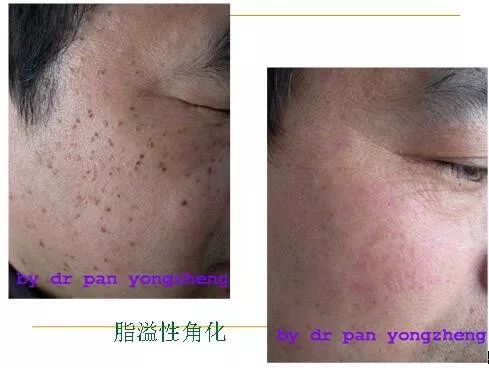 科普 | 关于激光在皮肤科上的应用