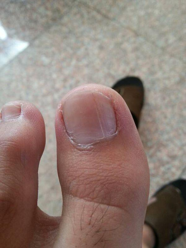 脚趾甲盖发白怎么回事