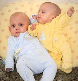 四个月出生的双胞胎婴儿, 体重仅有1斤, 却能奇
