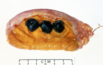 吃鸡内金可以辅助治疗胆结石吗?可惜很多人都