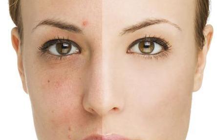 朵嘉浓玫玫老师;什么是闭口粉刺及闭口