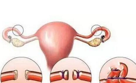 你的老公,愿意为你结扎吗?女性结扎竟然这么多