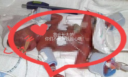 早产宝宝25周就出生了,接生医生看到宝宝的第