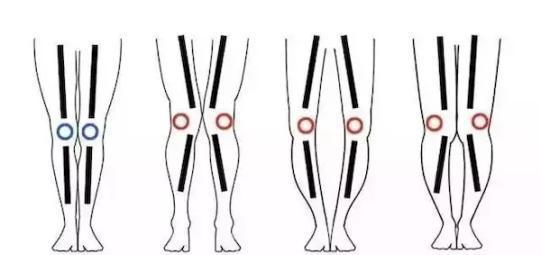 女生的4种腿型,你的属于正常范围吗?