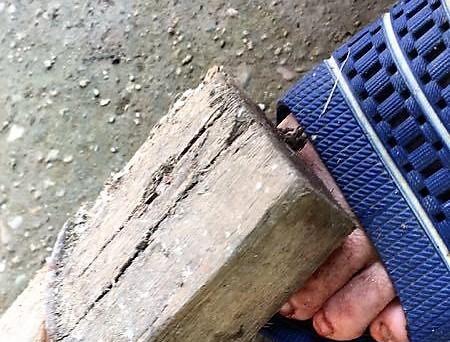 男子被木刺扎伤险些丧命,看看感染破伤风的风