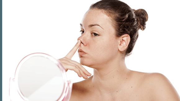 如何判断酒糟鼻? 这些偏方可以用哦!