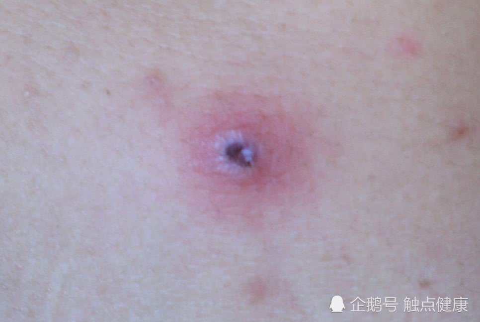 恙虫外观与蜱虫相似,能够传染恙虫病.
