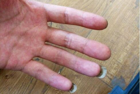 头皮容易油、容易脏, 是过敏头皮, 别用错洗发水