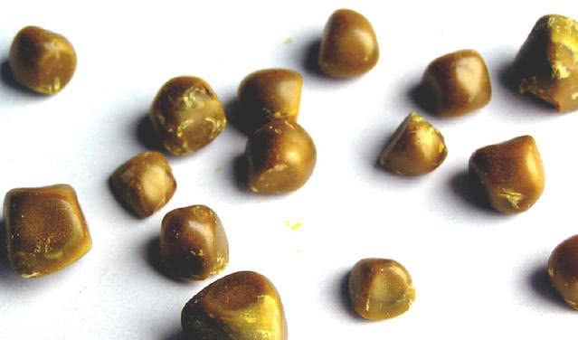 肾结石1.7cm如何治疗?不用手术也能清除,而且