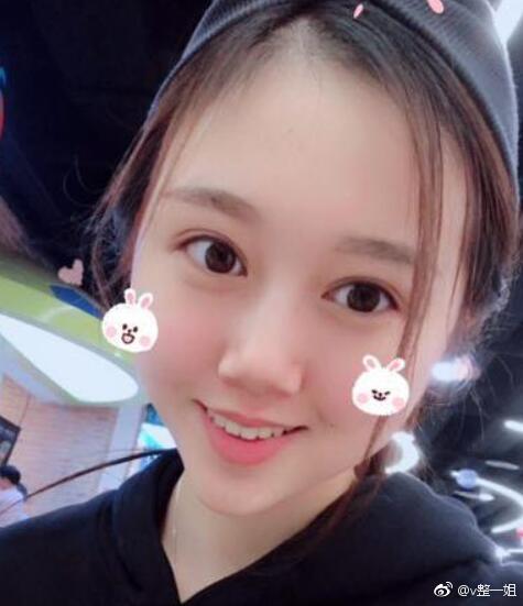 北京定点双眼皮（韩式三点）手术案例分享，术后两个月恢复过程。