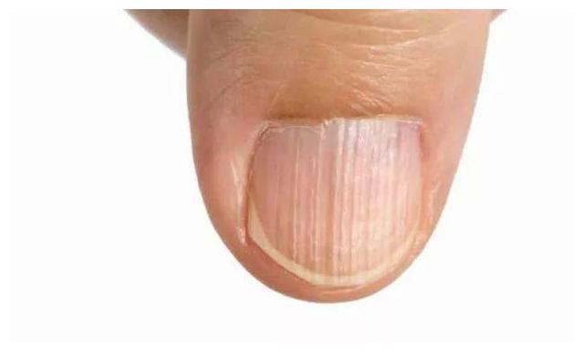 8种能正确反映您身体疾病的指甲类型