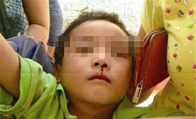 4岁孩子幼儿园流鼻血死亡, 得知原因, 老师和父母哭成一团